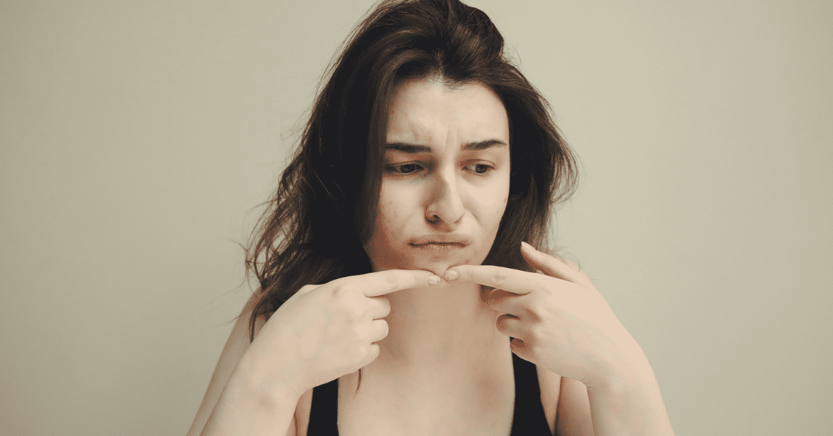aloe vera e acne