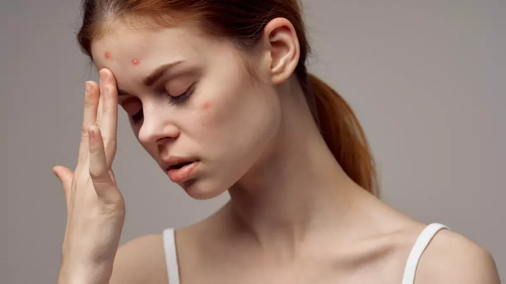 acne e brufoli
