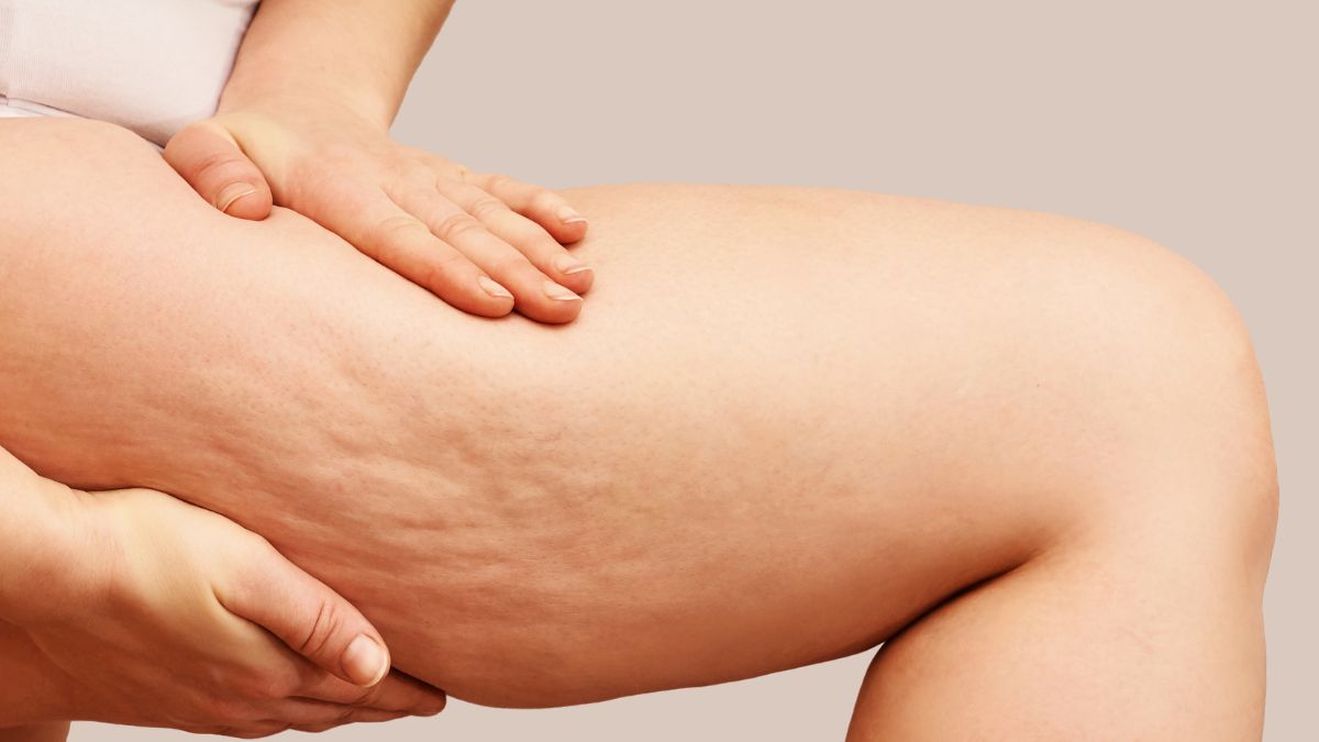 linfa di betulla cellulite