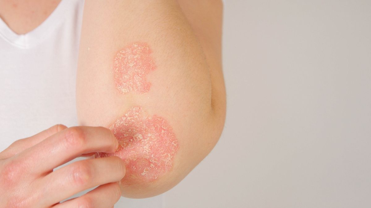 crema per psoriasi