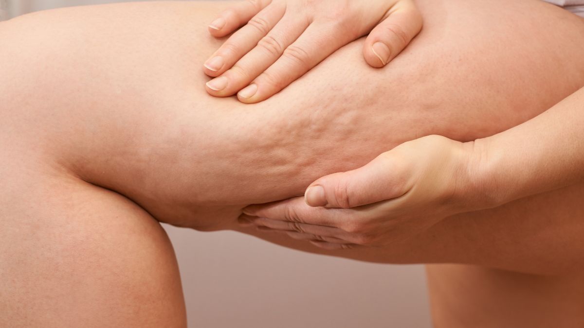 cellulite e ritenzione idrica